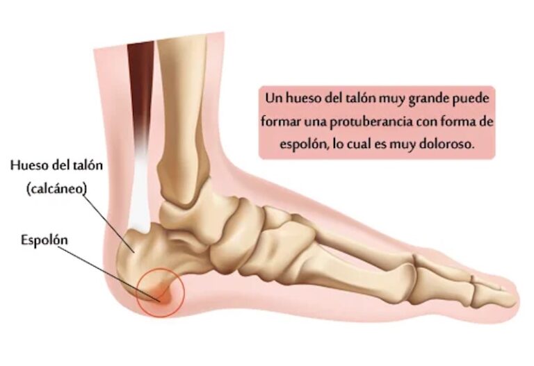 Spolon Radiography Espolón calcáneo: causas, síntomas y tratamiento