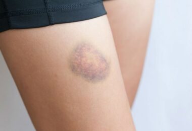 Aparición de moretones en las piernas