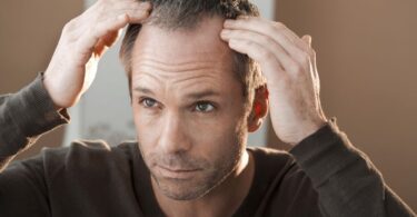 Primeros signos de alopecia