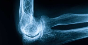 Huesos con osteoporosis