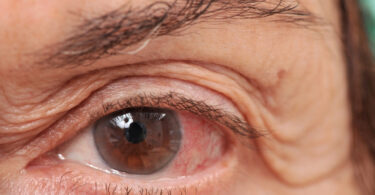 Señales de riesgo de glaucoma