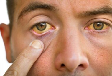 Signos de colesterol malo que se pueden detectar en los ojos