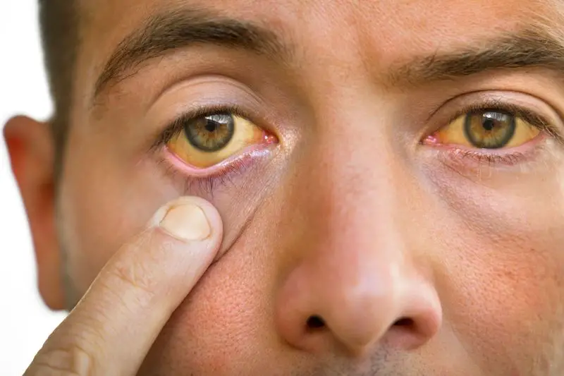 Signos de colesterol malo que se pueden detectar en los ojos