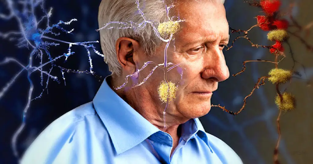 Los primeros signos de la enfermedad de Alzheimer podrían aparecer en la nariz, según investigaciones