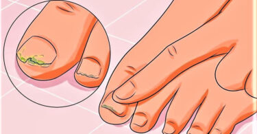 Hongos en las uñas y cómo tratarlo de forma natural