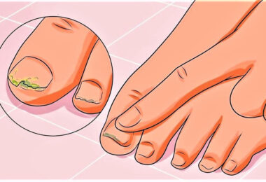 Hongos en las uñas y cómo tratarlo de forma natural
