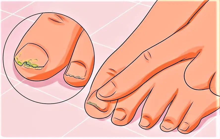 Hongos en las uñas y cómo tratarlo de forma natural