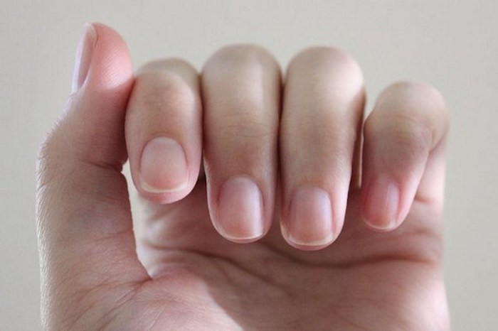 Cambios en las uñas reflejan problemas renales