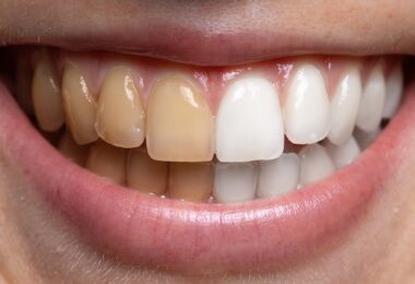 Dientes amarillos