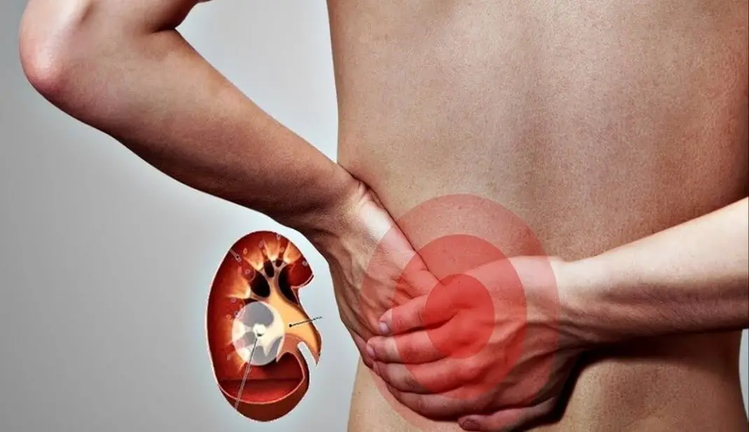 Hombre con dolor en la espalda por problemas renales