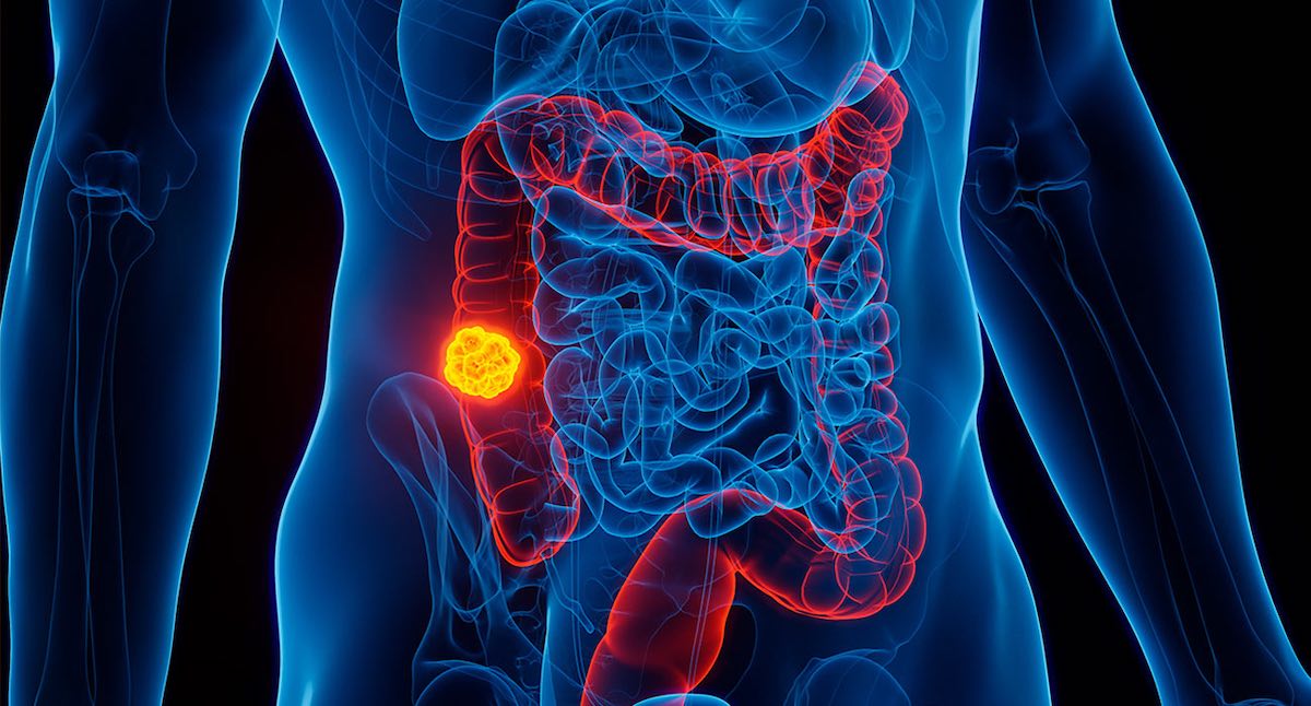 80% de los pacientes con cáncer de colon comparten este patrón en la dieta, según un veterano oncólogo